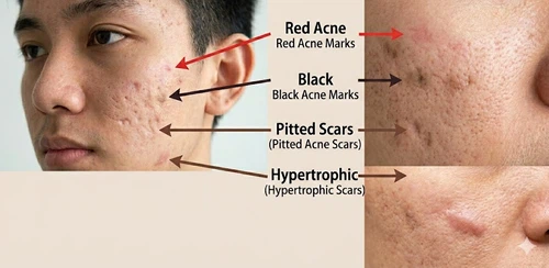 acne scars treatment acne scars treatment